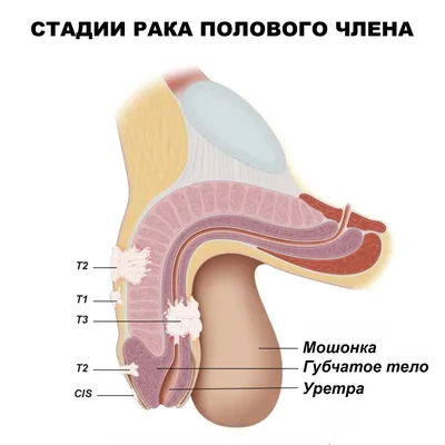 Атерома мошонки: симптомы и лечение атеромы на яичках и половом члене в  Москве