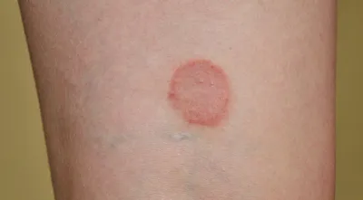 Герпес — Derma.ua