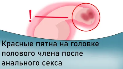 Причины и способы лечения покраснений на крайней плоти
