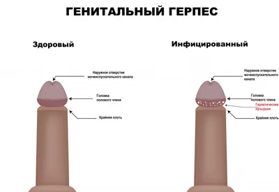 Трофическая язва, как быстро её вылечить в домашних условиях. | Практики в  природе | Дзен