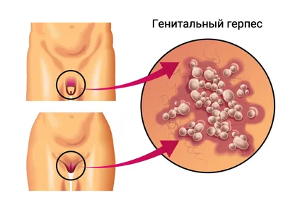 Эрозии на головке полового члена - YouTube