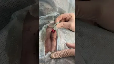 Герпес — симптомы и лечение | Блог Daily Medical