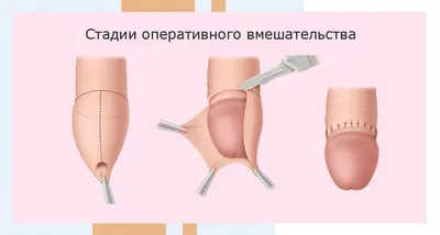 Язва — Википедия