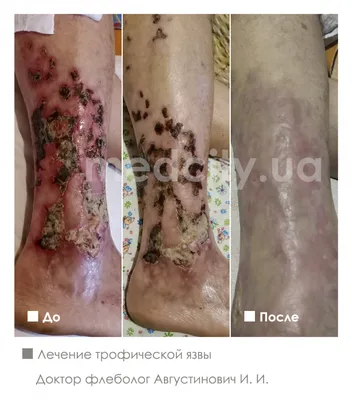 Псориаз – причины, симптомы, лечение