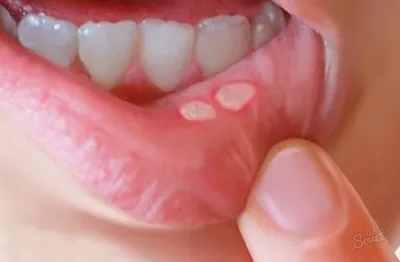 Белая болячка во рту — Стоматология «Doctor-RAF»