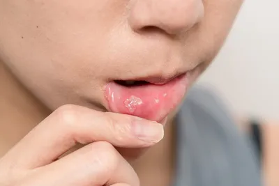 Во рту появилась белая язвочка: как лечить | Dental Art