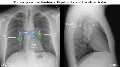 NIH Clinical Center provides one of the largest publicly available chest  x-ray datasets to scientific community | National Institutes of Health (NIH)