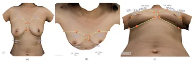 What Size Breast Implants Do I Need to Go Up One Cup? - Swan Center for  Plastic Surgery