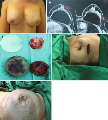 Restoring Breast Volume in High BMI Patients: A Single-Center Review of  Breast Reconstruction Using Hyperinflated Saline Implants