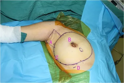 Breast Augmentation B To C Cup - Dr Mark Duncan-Smith