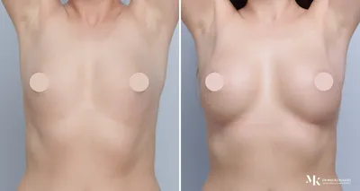 Top 5 Breast implant sizes for Breast augmentation - Cosmeticsurg