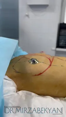 36 F After Breast Augmentation | Petrungaro Plastic Surgery