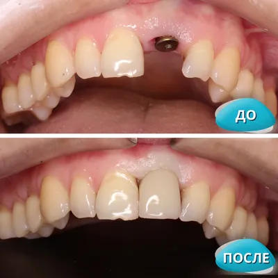 Импланты зубов фото до и после фотографии