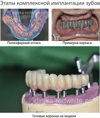 Комплексная имплантация зубов. Фото отчет до и после имплантации зубов