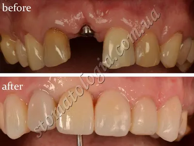 Имплантация зубов в Киеве - клиника имплантологии зубов, отзывы, цены |  Стоматология Киев