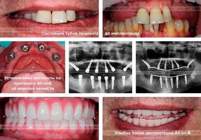 Имплантация по протоколу All-on-4/6 цены в Минске, отзывы, стоимость
