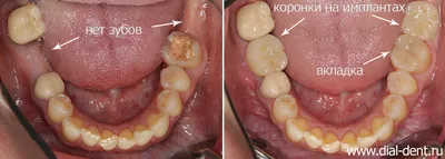 Имплантация двух нижних зубов с пластикой мягких тканей