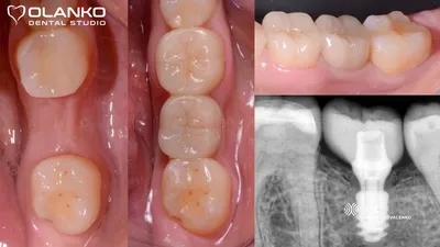 Имплантация зубов в Хабаровске: цена за 51 200 ₽ под ключ – EsteticaDent.ru