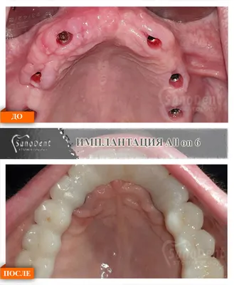 Импланты зубов: фото до и после в Санкт-Петербурге