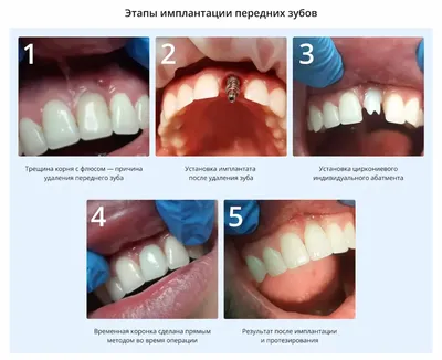 Протезирование All-on-4: фото до и после в Санкт-Петербурге