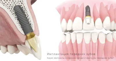 Кому нужна имплантация — стоматология Лукашука на Теремках