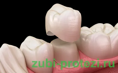 Какими бывают искусственные зубы? | Стоматология Королевская улыбка | Дзен