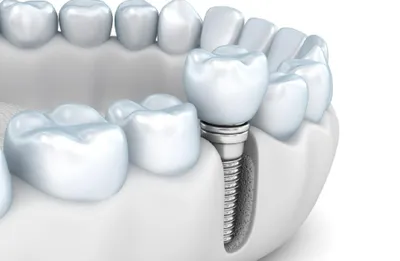 Мостовидные протезы зубов в Уфе | Стоматология Риадент