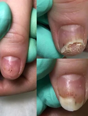 Ожог ногтевой платины | Онихолизис после ожога ногтя - как восстановить  ногтевую пластину | Советы nail-мастера - Фото