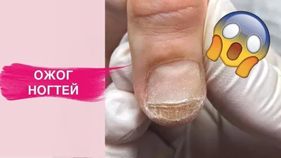 ONICHOLYSIS and BURN of the nail plate? Why? What to do? - YouTube