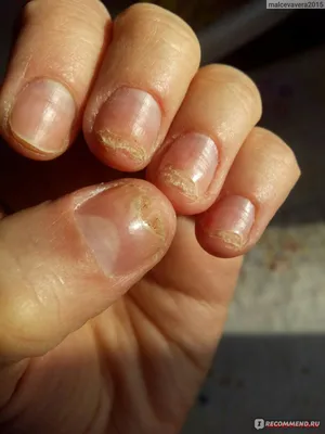 Испорченные ногти после гель лака фотографии