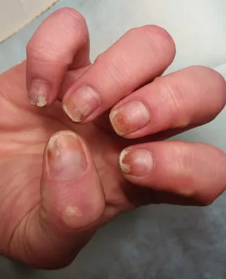 Ожог ногтей гелем-лаком: лечение в Москве. Клиника Меднейл