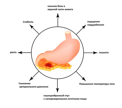 Острый панкреатит: симптомы и лечение | МРТ Эксперт