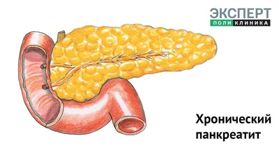 Хронический панкреатит - описание, симптомы и лечение / Гастро-гепатоцентр  ЭКСПЕРТ