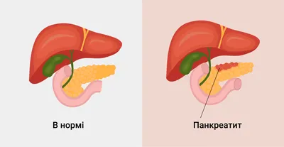 ⚕ Панкреатит: симптомы, причины, лечение ➡ Киев