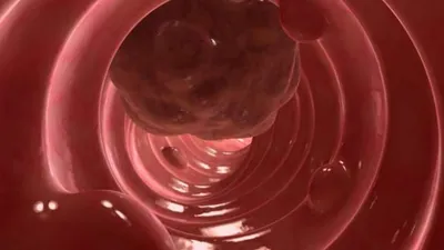 Кал при раке кишечника: цвет, анализ, форма, фото, форум - все про кал при  онкологии