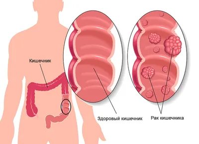 Диагностика рака кишечника. Booking Health