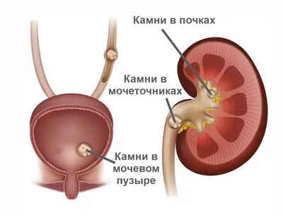 Камни в почках - причины появления и как избавиться | Блог Daily Medical