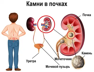 Как мне удаляли камень из почки после родов | Любовь Бобровская | Дзен