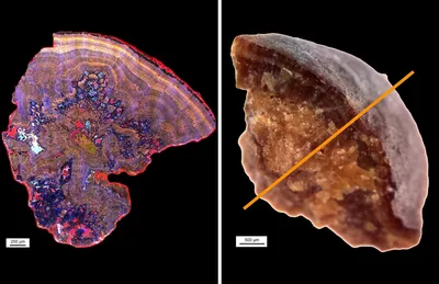 Камни в почках под микроскопом краше кораллов | Пикабу