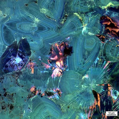 Камни в почках под микроскопом краше кораллов | Пикабу