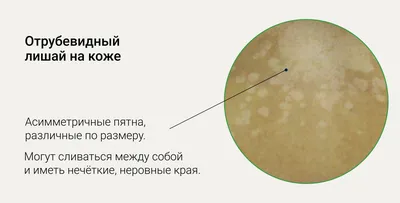 Кандидоз: симптомы, диагностика и лечение