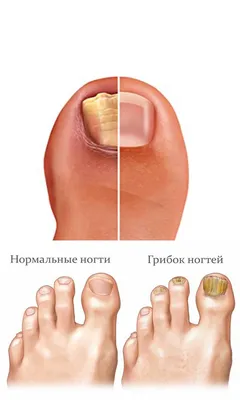 Грибок ногтей, лечение. Причины и симптомы грибка ногтей.