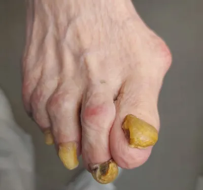 Грибы растут из плит ногти на ногах. Концепция кожи грибка и инфекций для  ногтей.. 2 Ноги с грибным крупным планом внутри Стоковое Изображение -  изображение насчитывающей макрос, грибок: 201193955