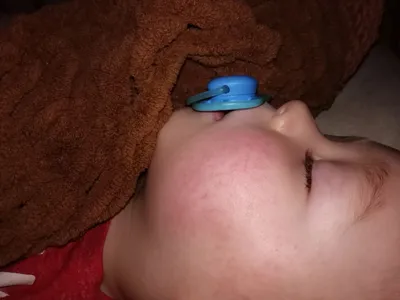 Видно сосуды на лице у ребёнка — 18 ответов | форум Babyblog