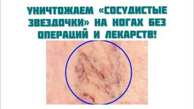 сосуды на ногах — 25 рекомендаций на Babyblog.ru