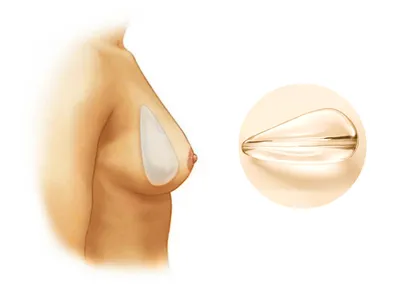 Увеличение груди (маммопластика) - Лучшие клиники - MedTour