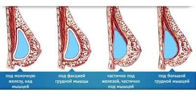 Анатомические импланты для груди - Исамутдинова Г. М.