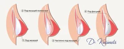 Маммопластика: сколько стоит сделать грудь, фото до и после операции,  реабилитация