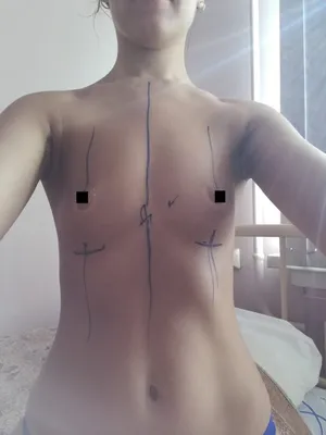 Увеличение груди в Киеве - цена операции в Украине на силиконовую грудь