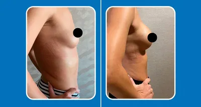 Увеличение груди в клинике в Москве | сколько стоит сделать грудь, фото до  и после, цены